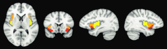 Tři podoblasti pravé insuly identifikované pomocí klastrové analýzy ventrálního předního svalu